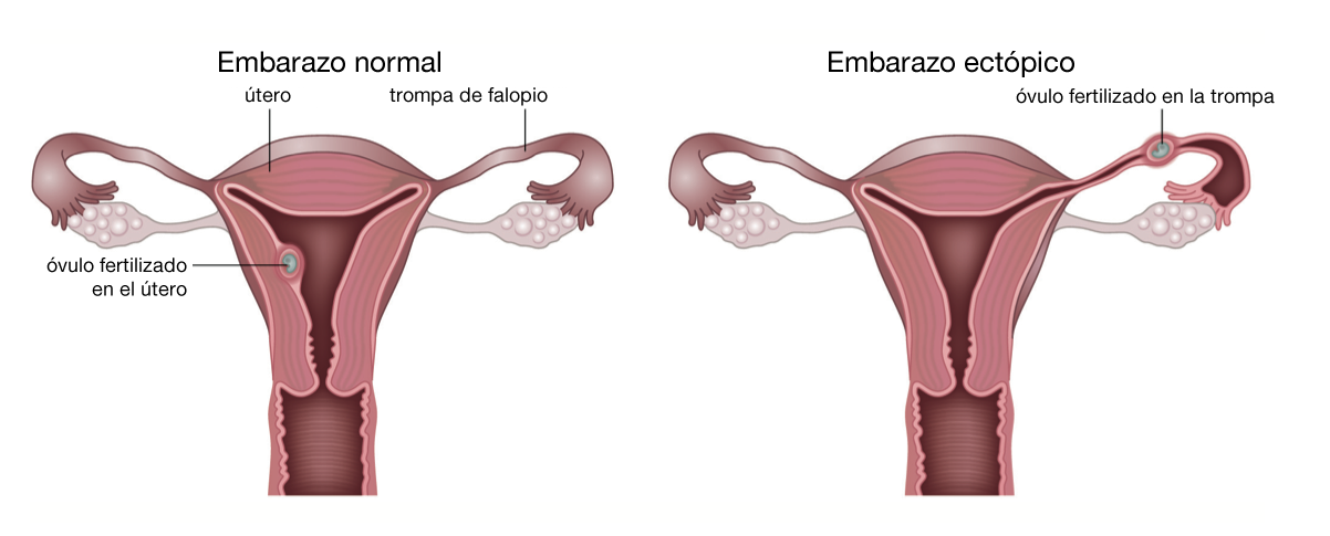 embarazo-ectopico-esquema
